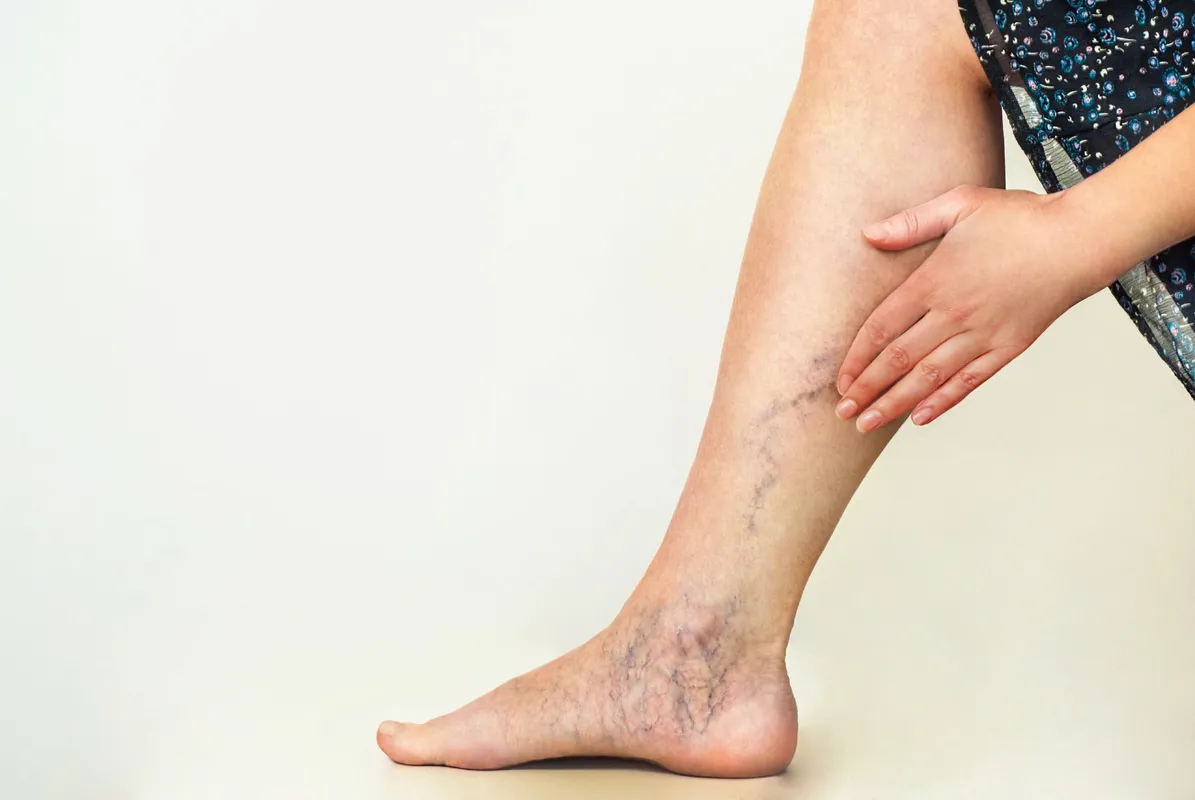 Varicose veins